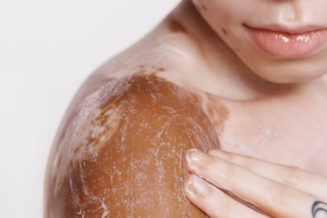 How to Treat Keratosis Pilaris, Eczema, and Other Common Skin Conditions